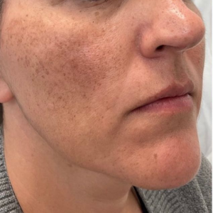 Calgary Micro needling treatment Before