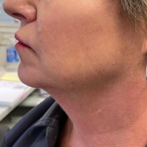 Jaw Filler Treatment Calgary After Photo-1