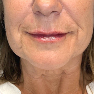 Lip Filler Treatment Calgary After Photo-2