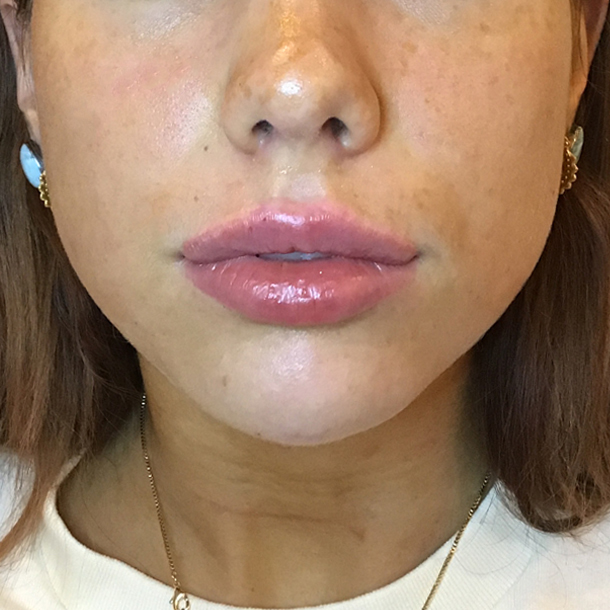 lip and cheek filler Before front Faces By K Cochrane