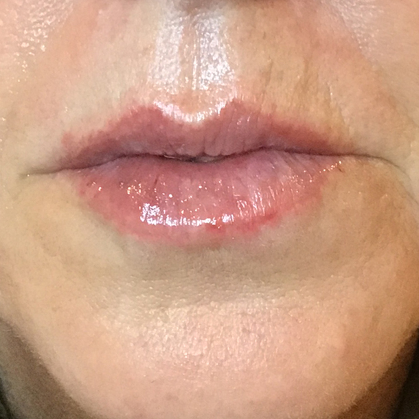 lip filler after treatment Faces By K Cochrane