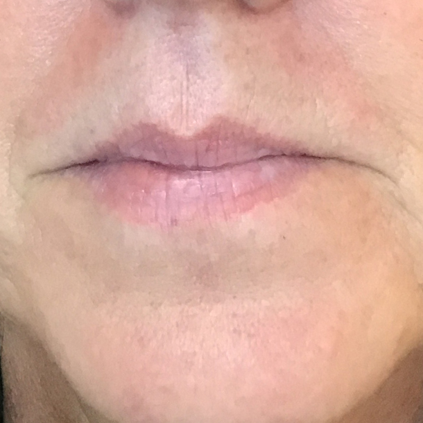 Lip filler treatment before picture Faces By Kathy Cochrane